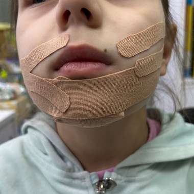 Кінезіотейпування для дітей від трьох років з гіпотонусом артикуляційного апарату
