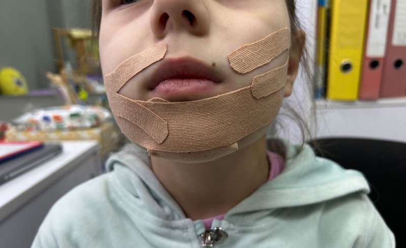 Кінезіотейпування для дітей від трьох років з гіпотонусом артикуляційного апарату
